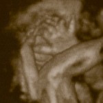 3d ultrasound